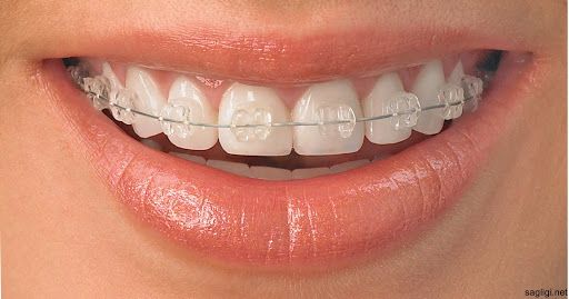 Devlet Hastaneleri Diş Teli Takar Mı? 2020 Devlette Diş Teli Tedavisi Fiyatları 6
